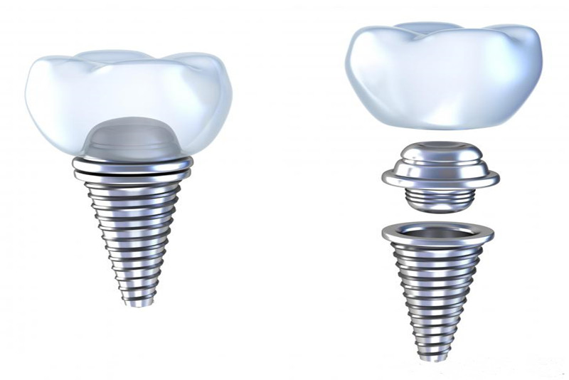 implant dentaire.jpg